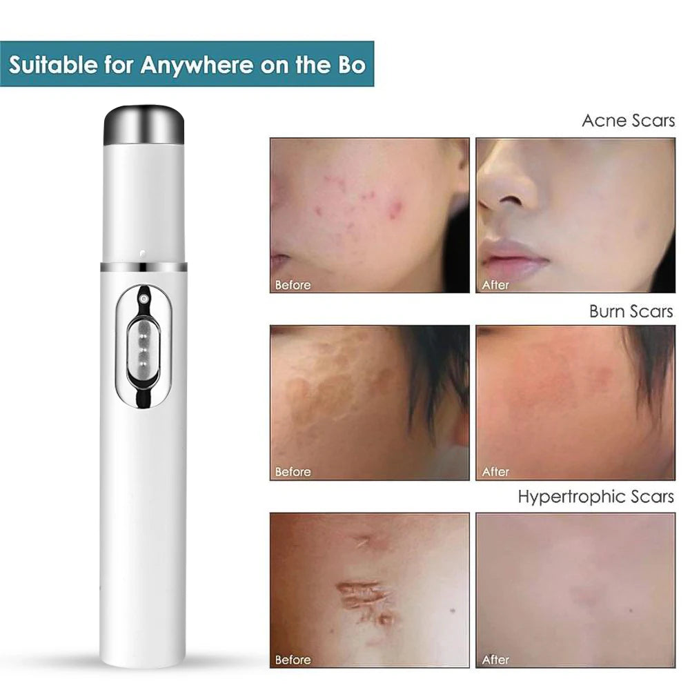 Blue Light Acne Remover Pen