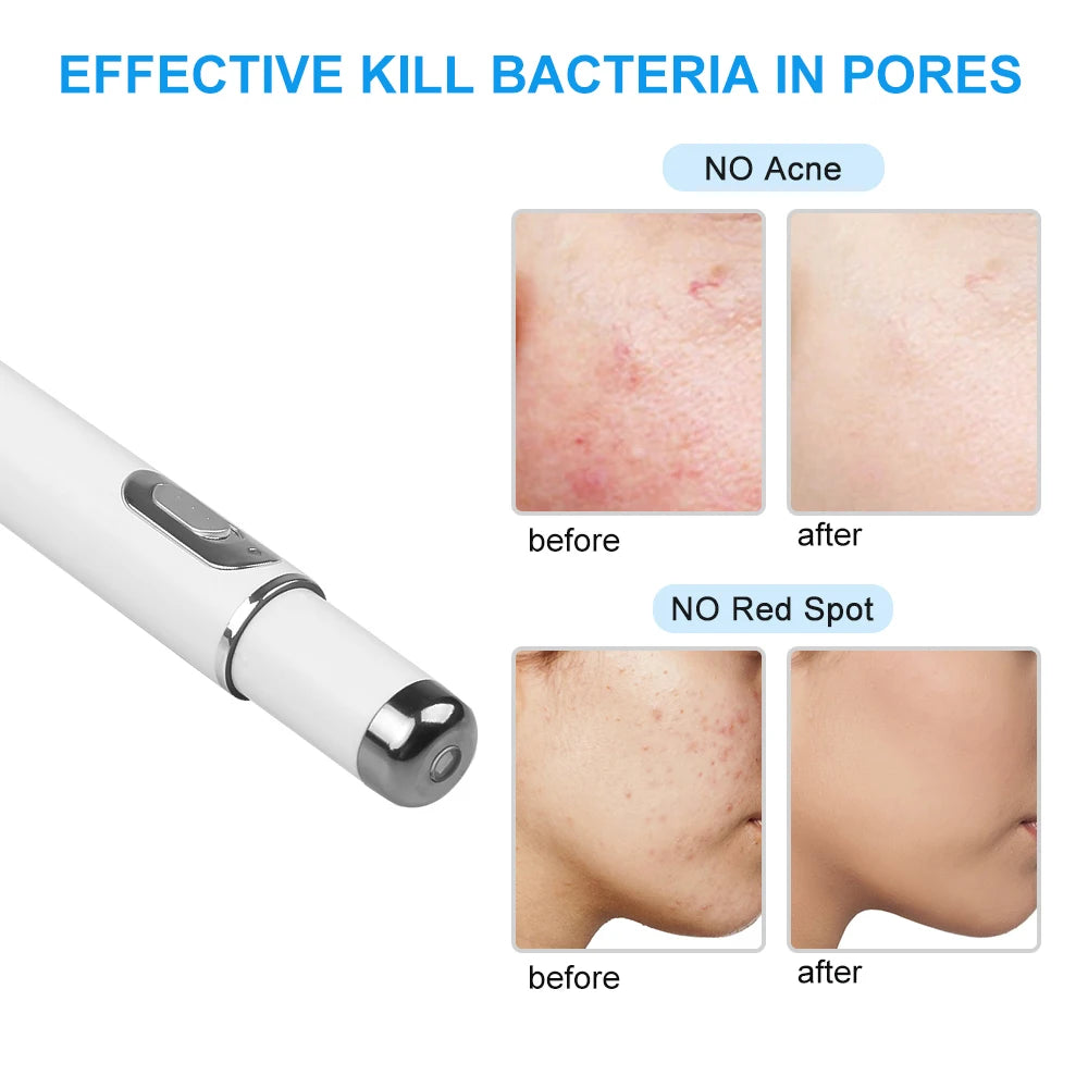 Blue Light Acne Remover Pen